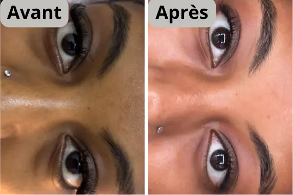 Avant après patch anti-cernes eclora Suisse Image